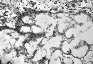 F,22y. | Pindborg tumor F,22y. | Pindborg tumor